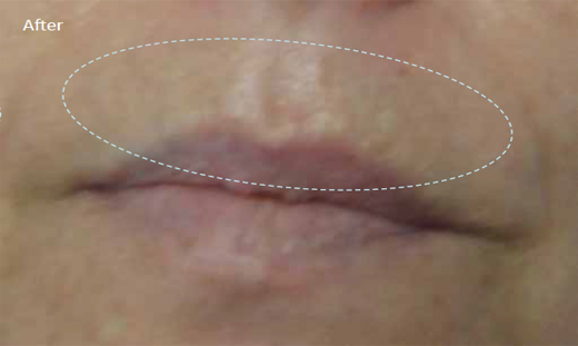 Radiofrequency-skin-tightening-combination-treatment-with-Diamond-peeling-4b-after-one-treatment