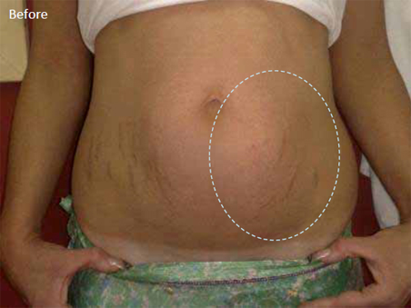 Radiofrequency-skin-tightening-for-post-natal-stretch-marks-1a-before