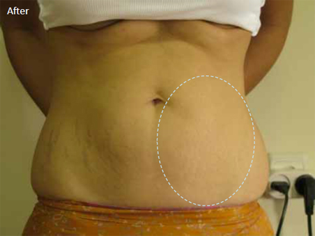 Radiofrequency-skin-tightening-for-post-natal-stretch-marks-1b-after-four-treatments