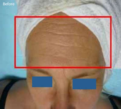 Radiofrequency-skin-tightening-for--wrinkles-combination-treatment-with-Diamond-peeling-1a-before