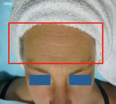 Radiofrequency-skin-tightening-for--wrinkles-combination-treatment-with-Diamond-peeling-1b-after-one-treatment