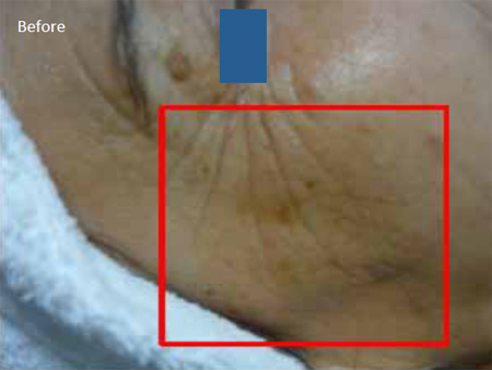 Radiofrequency-skin-tightening-for--wrinkles-combination-treatment-with-Diamond-peeling-2a-before