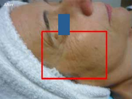 Radiofrequency-skin-tightening-for--wrinkles-combination-treatment-with-Diamond-peeling-2b-after-two-treatments