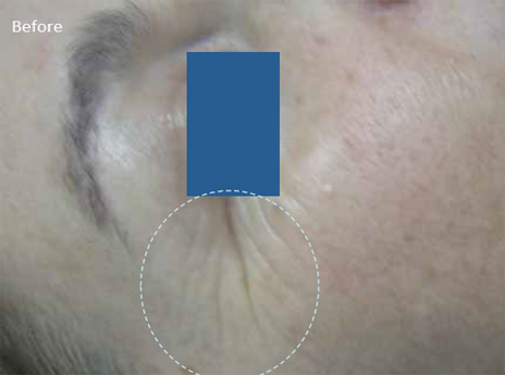 Radiofrequency-skin-tightening-for--wrinkles-combination-treatment-with-Diamond-peeling-3a-before
