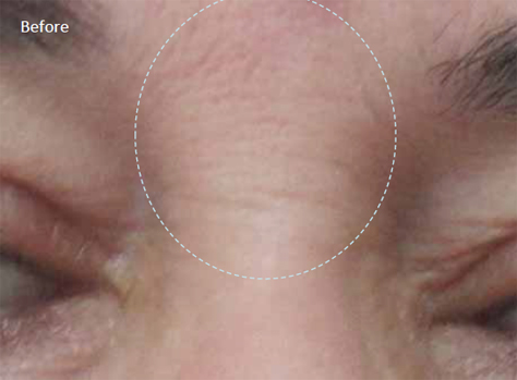 Radiofrequency-skin-tightening-for--wrinkles-combination-treatment-with-Diamond-peeling-4a-before