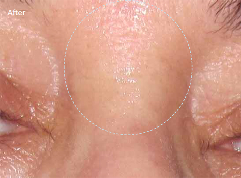 Radiofrequency-skin-tightening-for--wrinkles-combination-treatment-with-Diamond-peeling-4b-after-8-treatments