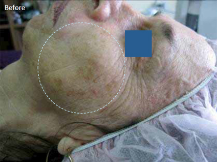 Skin-rejuvenation-for-pigmented-lesions-1a-before