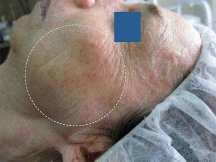 Skin-rejuvenation-for-pigmented-lesions-1b-after-three-treatments