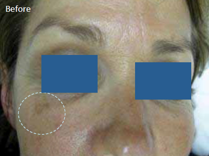 Skin-rejuvenation-for-pigmented-lesions-2a-before