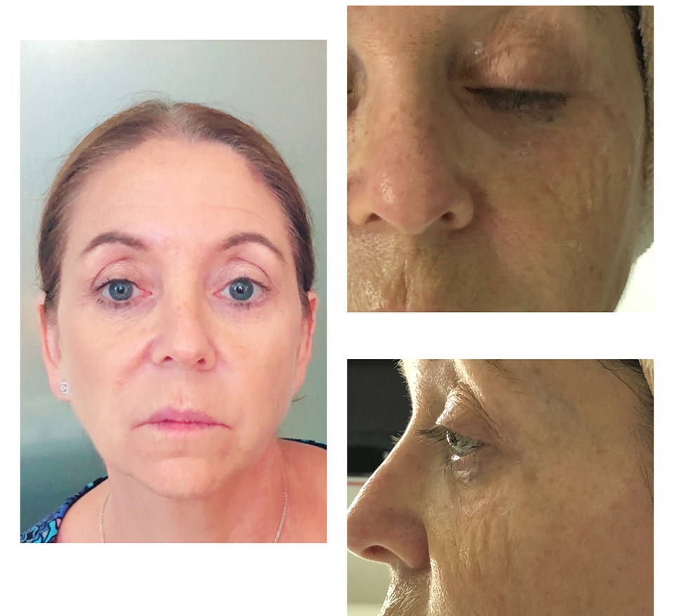 before and after Intracel treatment